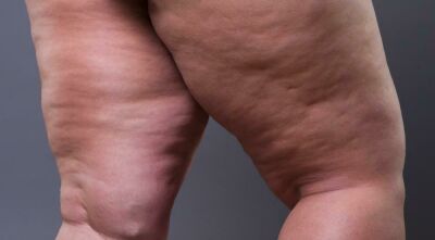 Imagem da notícia Clinica Vision Estétic oferece tratamento para Lipedema com suplementação e consultas estética de cortesia